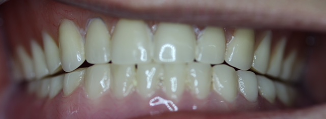 After Lower Implant